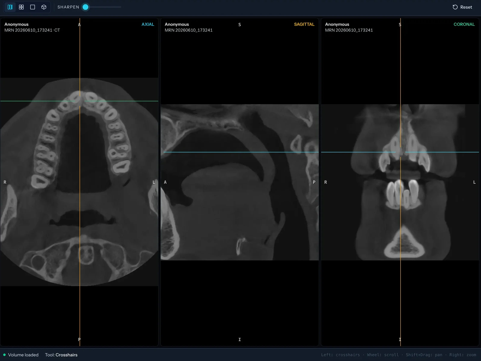 The Nuvirad viewer displaying a CT study opened straight from local files